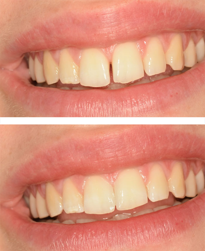 faccette dentali estetiche