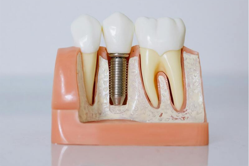 impianti dentali